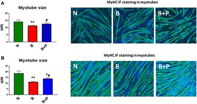 Molecular Mechanisms Responsible for the Rescue Effects of Pamidronate on Muscle Atrophy in Pediatric Burn Patients